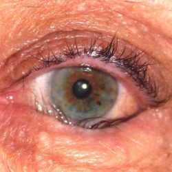 Eyelid lesions oculus