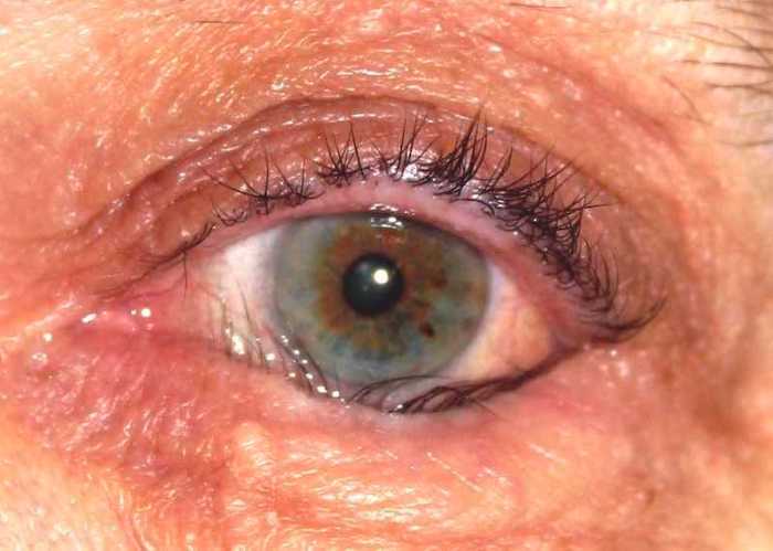 Eyelid lesions oculus
